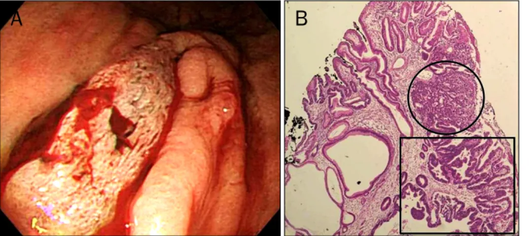 Table 2. Summary of Data on Gastric Hyperplastic Polyps with Neoplastic Transformations