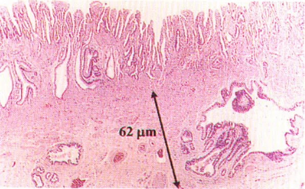 Fig. 4. The permeation of lymphatic ducts or vessels. Permeation of lymphatic duct or  ves-sels are observed in submucosal layer (H&amp;E stain, ×400).
