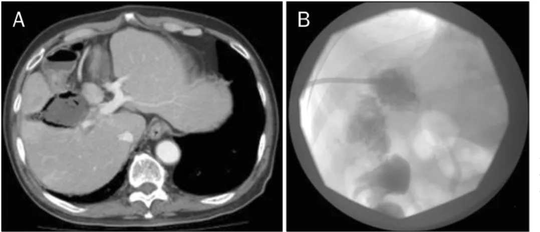Fig. 2. (A) CT showed 6 cm sized  air-bubble containing liver abscess  and communication with hepatic  flexure of colon