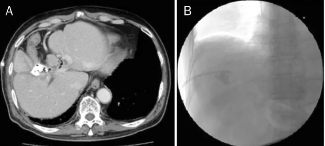 Fig. 4. CT scan obtained 3 months after removal of percutaneous catheter drainage. CT showed resolution of liver abscess and  communication with colon