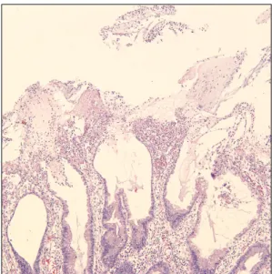 Fig. 3.  Pathologic finding of colonoscopic biopy. It showed the surface of polyps covered by exudates (H&amp;E, ×100).