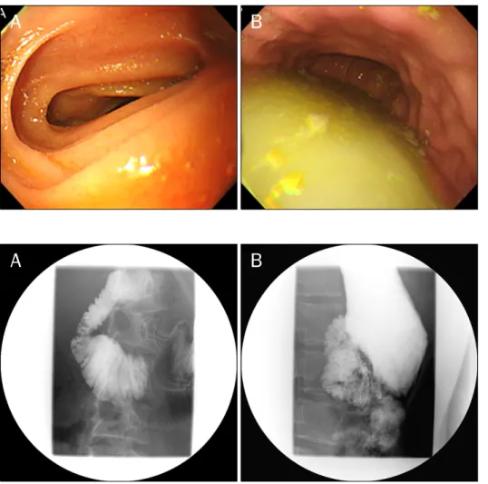 Fig. 1. Endoscopic findings. (A) Partial obstruction of the third portion of  duodenum was observed