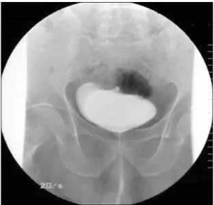 Fig. 3. CT scan finding. (A) There was  about 1.5 cm sized fistular tract  between the sigmoid colon and  posterior wall of the urinary bladder  (white arrow)