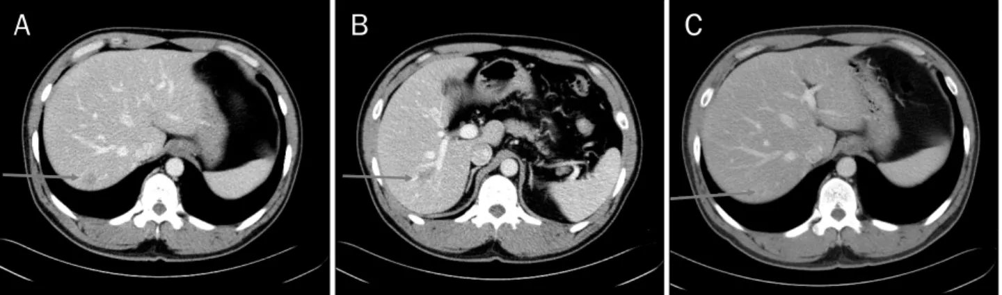 Fig. 1. (A) CT showed 20 mm sized, well-defined, and faintly low attenuated mass in the S8 of the liver