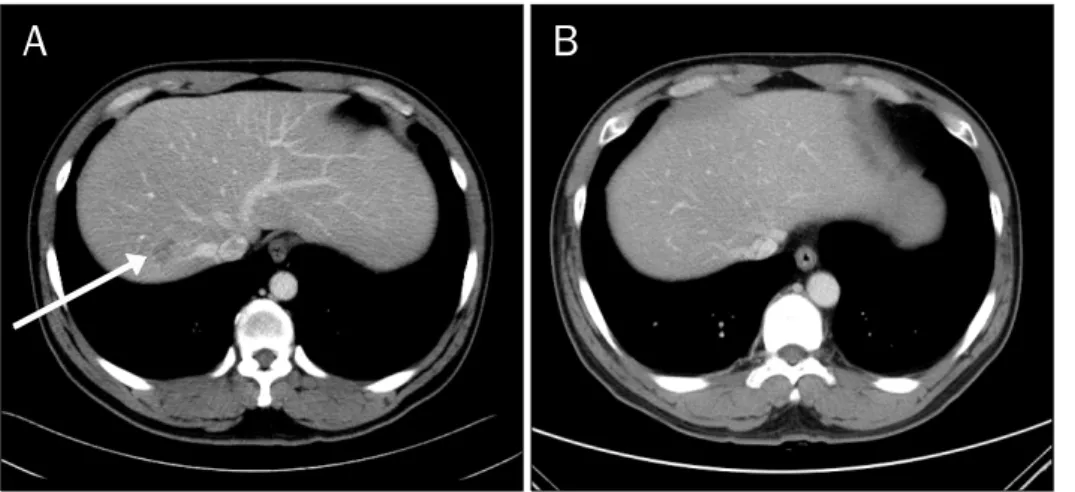 Fig. 2. (A) Follow up CT (after 10  weeks) showed 23 mm sized  low  attenuated lesion with irregular shape  in the S7 of the liver