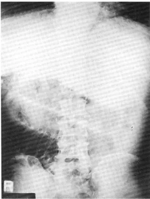 Fig. 1. Simple abdominal radiographic finding. Plain ab- ab-dominal film at the admission showed markedly gaseous distended small bowel loops in the middle abdomen and splenomegaly.