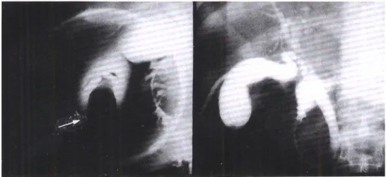 Fig. 4. Evacuated material. Amorphous blood clots were evacuated via percutaneous cholecystostomy tube from gallbladder.