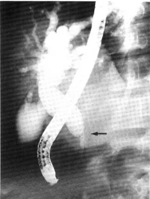 Fig. 2. Endoscopic retrograde cholangiographic finding.