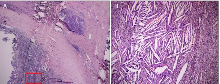 Fig. 4. Microscopic finding of resected specimen. It showed a large number of spindle shaped cholesterol crystals (cholesterol cleft) surrounded by multinucleated giant cells and hemosiderin deposits (A: H&amp;E, ×40, B: H&amp;E, ×400)