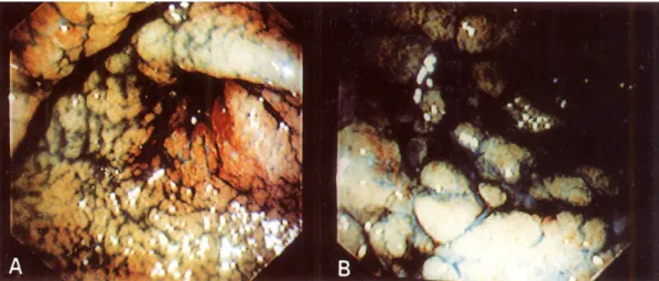 Fig. 1. Upper gastrointestinal endoscopic findings. They showed circumferential area of diffusely irregular mucosa with cobblestone appearance and multiple erosions on the antrum (A) and body extending into the second portion of the duodenum (B) after Indi