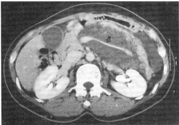 Fig. 2. Contrast-enhanced CT scan. Contrast-enhanced CT scan shows a huge low attenuated mass involving the pancreas body and tail