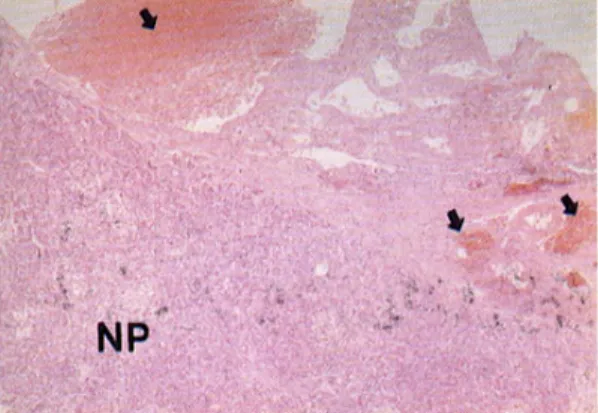 Fig. 4. Microscopic finding. A relatively well demarcated lesion composed of dilated blood-filled spaces (arrows) was lined by flattened endothelial cells (H&amp;E stain, ×40), NP, normal pancreas.