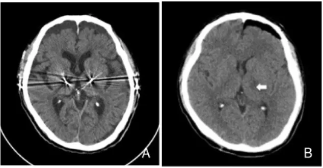 Figure 4.   Brain computed tomography scans of patients with es- es-sential tremor who received bilateral thalamic deep brain  stimulation (A) and left thalamotomy (B)