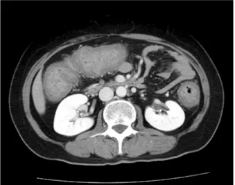 Fig. 2. Colonoscopic findings. (A) It  demonstrated diffuse nodular  le-sions with bleeding and friability at the ascending colon