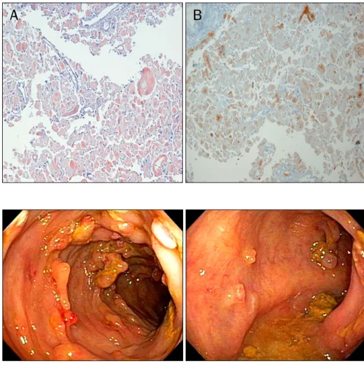 Fig. 3. Microscopic findings (Congo-  red stain, ×100). (A) Congo-red stain  revealed pink red deposits in the  lamina propria of the colon