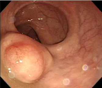 Fig. 1. Colonoscopic finding. There was about 25 mm sized bulging mucosa with focal cystic portion in the rectum.