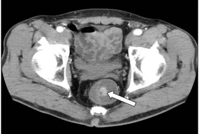 Fig. 4. Endoscopic findings. (A) After  mucosal biopsy, mucoid fluid was  flowed from the mass to the lumen of the rectum
