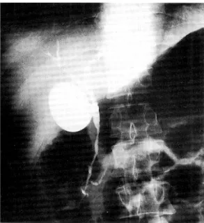 Fig. 4. ERCP finding. ERCP shows segmental stenosis and irregular narrowing of the common bile ducts.
