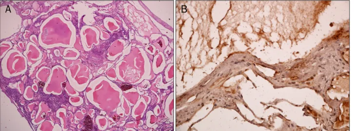 Fig. 4. Microscopic finding. (A) Mass was composed of irregularly shaped vascular channels filled acellular homogeneous lymph fluids (H&amp;E, 