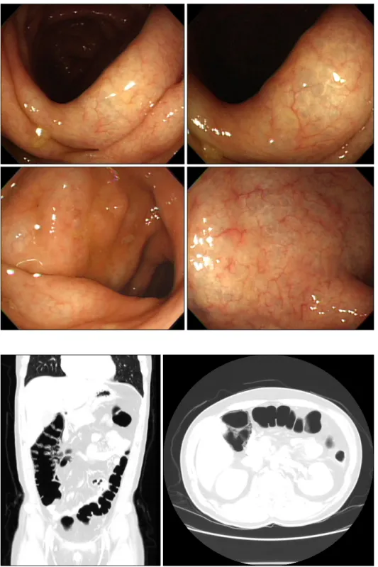 Fig. 1. Colonoscopy showed diffuse  wall thickening with pale and  translu-cent mucosal change in the hepatic  flexure and ascending colon.