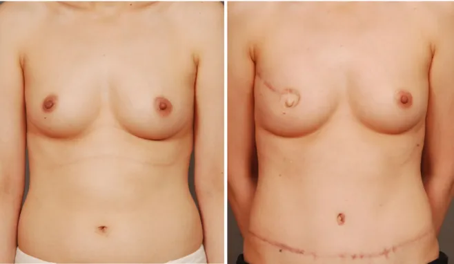 Figure 6.   Delayed reconstruction was performed with transverse rectus abdominis musculocutaneous (TRAM) flap for 54 year-old lady  who lost her right breast after modified radical mastectomy