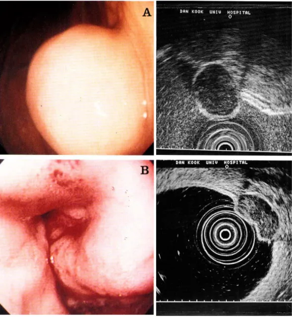 Fig. 1. Two cases of gastric benign stromal cell tumor. (A) Endoscopic image of a submucosal tumor on gastric body and its endosonographic image of 2.5 ㎝ sized homogenous with regular outer margins