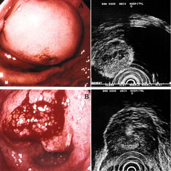 Fig. 2. Two cases of gastric malignant stromal cell tumor. (A) Endoscopic image of a submucosal tumor with central ulceration located in gastric body and its endosonographic image of 6 ㎝ sized large tumor with multiple central necrosis