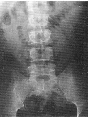 Fig. 1. Abdominal X-ray finding. It shows abnormal gas pattern in segmented bowel and diffuse bowel wall  thick-enings.