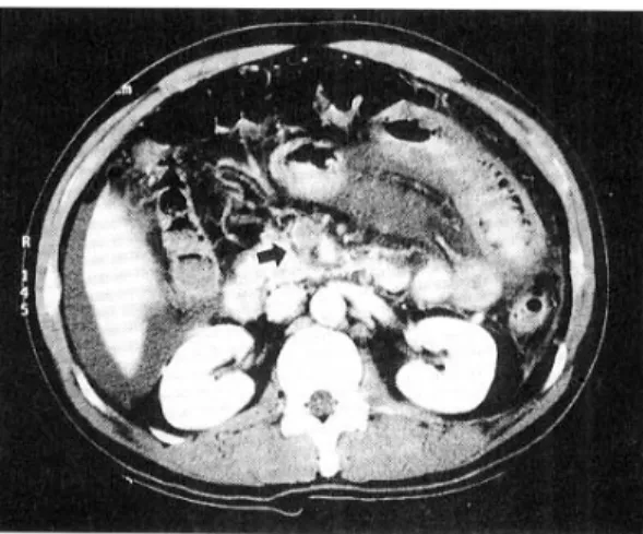 Fig. 3. Superior mesenteric artery angiography finding. It reveals delayed filling in capillary bed and collateral vessels (arrow) in medial side of portal vein.