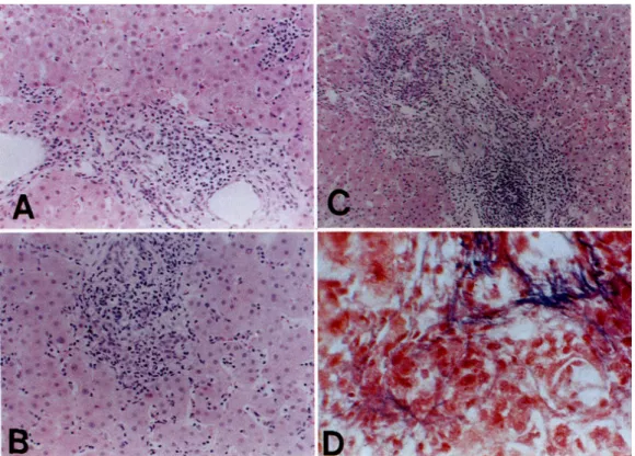 Fig. 1. Various degree of histopathologic severity in chronic hepatitis C. (A) Mild degree of severity
