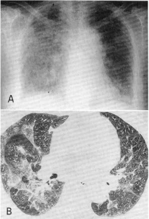 Fig. 1. Chest radiograph and HRCT after 1 week of interferon therapy. (A) Chest radiograph shows diffuse ground-glass opacification in the right lung and reticulonodular shadows in the left lung., (B) HRCT scan shows patchy areas of ground-glass opacity in
