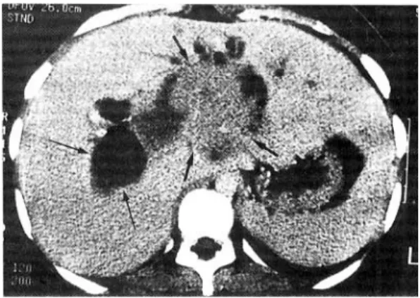 Fig. 1. Abdominal computerized tomography scan. The abdominal C-T scan shows a large (6 cm), ill-defined, low attenuated mass (short arrows) in the proximal portion of the left hepatic duct