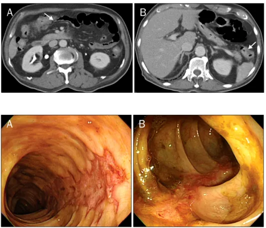 Fig. 1.   Abdominal CT findings. (A) It showed bowel wall thickening at the proximal transverse colon (arrow)