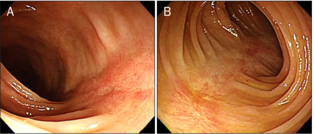 Fig. 4. Follow up colonoscopic finding 5 weeks after initial colonoscopy. It  showed complete healing of previous longitudinal ulcers and red  longi-tudinal scars only.