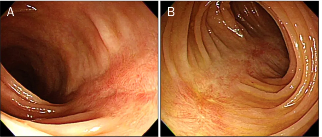 Fig. 4. Follow up colonoscopic finding 5 weeks after initial colonoscopy. It  showed complete healing of previous longitudinal ulcers and red  longi-tudinal scars only.