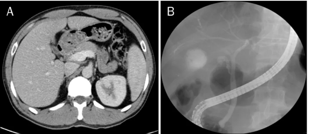 Fig. 1. Microscopically, hepatocytes contained diffuse intracellular deposits of brown pigment (arrows) without evidence of cell damage in liver biopsy in 1995 (H&amp;E, ×200).