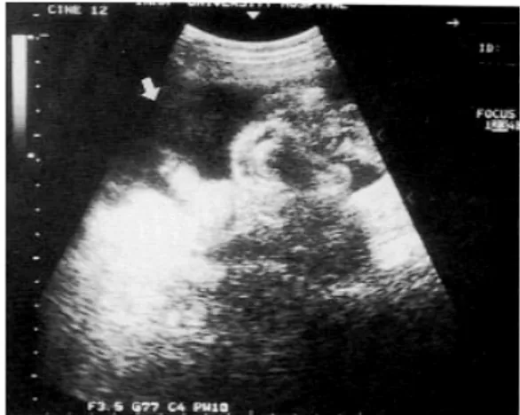 Fig. 2. Abdominal ultrasonogram. Abdominal ultrasono- ultrasono-gram shows low echogenic fluid collection in abdomen (arrow).
