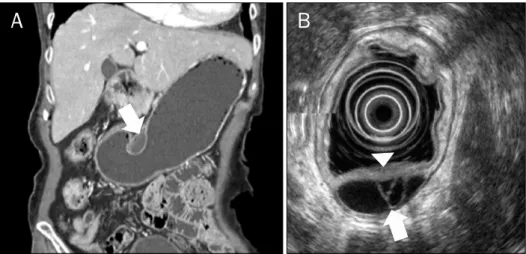 Fig. 1. (A) Stomach CT finding (3  years ago). It showed an about 3×