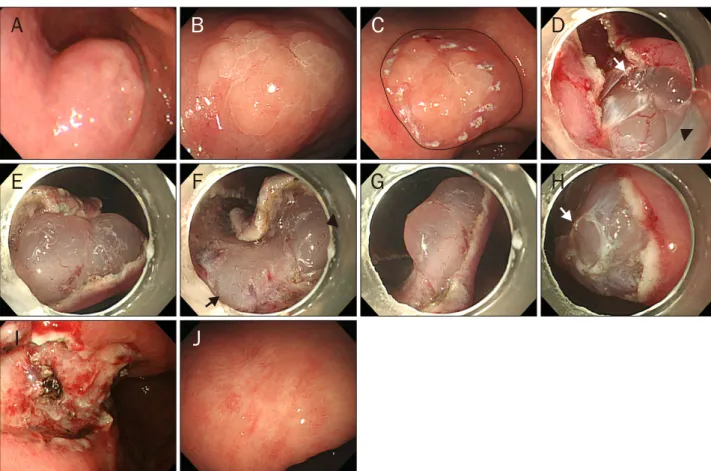 Fig. 2. Endoscopic images. (A) Endoscopy showed an about 3 cm sized slight translucent submucosal tumor accompanied with whitish  geographic mucosal lesion on its surface at the lesser curvature side of the lower body (3 years ago)