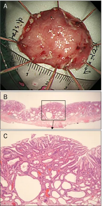 Fig. 3. (A) Gross finding. The endoscopic submucosal dissection  (ESD) specimen measured 3.2×2.5×0.3 cm