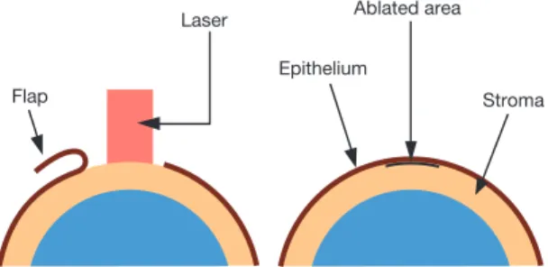 Figure 1.   Photorefractive keratectomy.