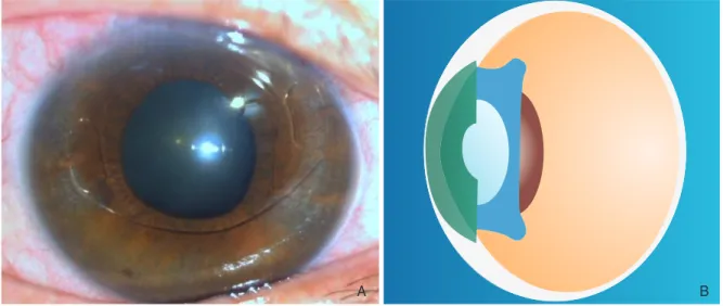Figure 6.   (A) Iris claw lens. (B) Implantable contact lens. 