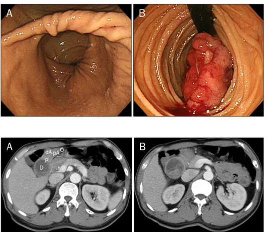 Fig. 1. An endoscopic finding. (A)  Endoscopy showed abnormal  con-vergence of the gastric folds from  antrum toward the pylorus,  sugges-ting intussuception in the duodenum