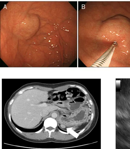 Fig. 1. Upper gastrointestinal endo- endo-scopy findings. (A) A gastric SMT-like  lesion was approximately 30 mm in  diameter
