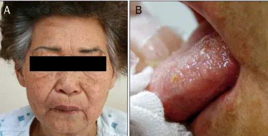 Table 1. Summary of Response to Infliximab Therapy in Patients with Orofacial Crohn’s Disease Age