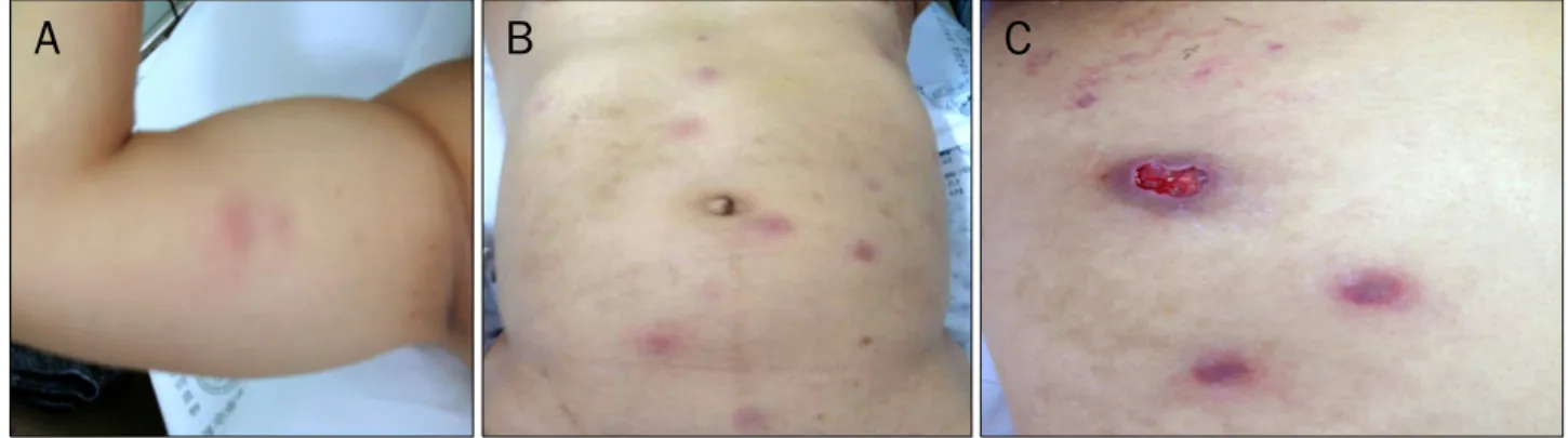 Fig. 1. Multiple tender, raised, annular erythematous lesions on the arms (A) and trunk (B)