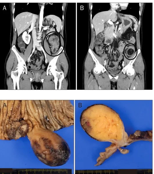 Fig. 2. Abdominal CT findings. (A) 