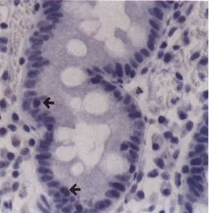 Table 2. Apoptosis Index, PCNA Index and Bcl-2 Expression before and after Treatment of H