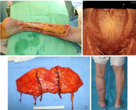 Figure 13.     Malignant melanoma, left sole. (A) 3x1.5 cm sized melanoma on the left sole