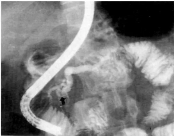 Fig. 1. A. An endoscopic retrograde pancreatographic (ERP) finding on presentation. The main pancreatic duct and branch ducts are diffusely dilated and a short segment stricture is noted on the head of the pancreas (arrow).